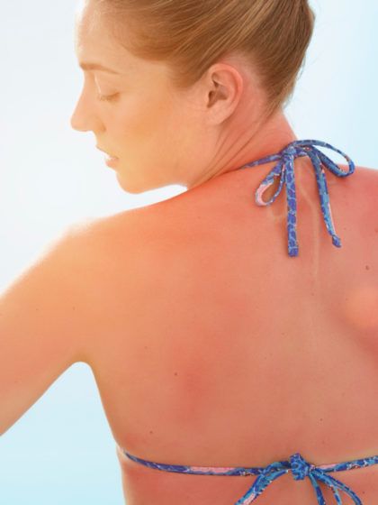 Welches Aftersun Produkt ist das Richtige gegen Sonnenbrand: Creme, Gel oder Lotion?