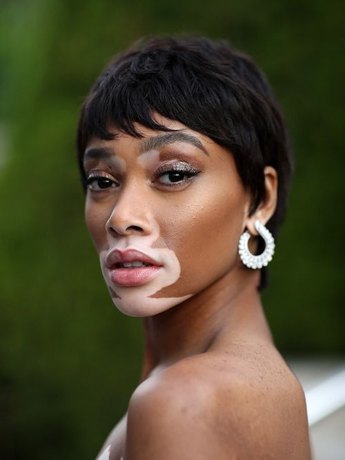 Winnie Harlow, Chantelle winnie, vitiligo, Canada model, Canada, Canadian, model, beauty standards, diversity, diverse, curvy, black, white, asian, fat, thin, instagram