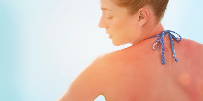 Frau im Sommer mit Sonnenbrand