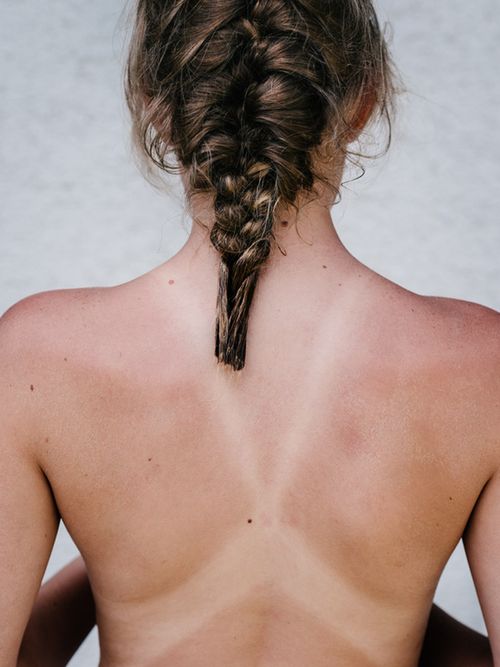 5 of the best remedies for sunburn, 