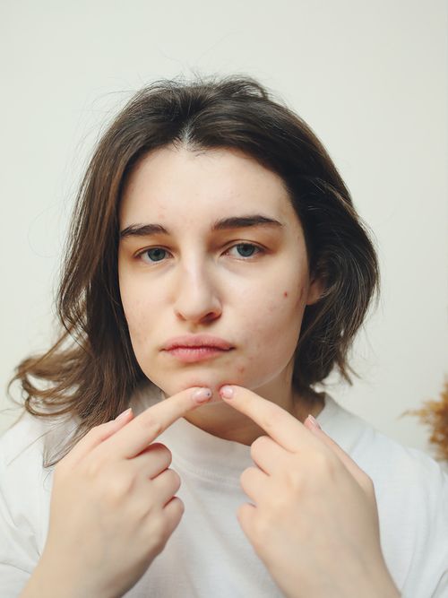 This is why you're experiencing adult acne, acne on my chin, why am I getting acne as an adult, how to treat adult acne, what products work for adult acne