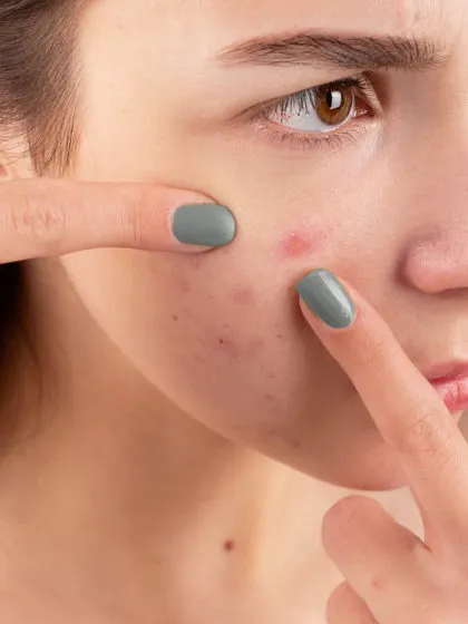 S.O.S. acne: come eliminare i segni dei brufoli?